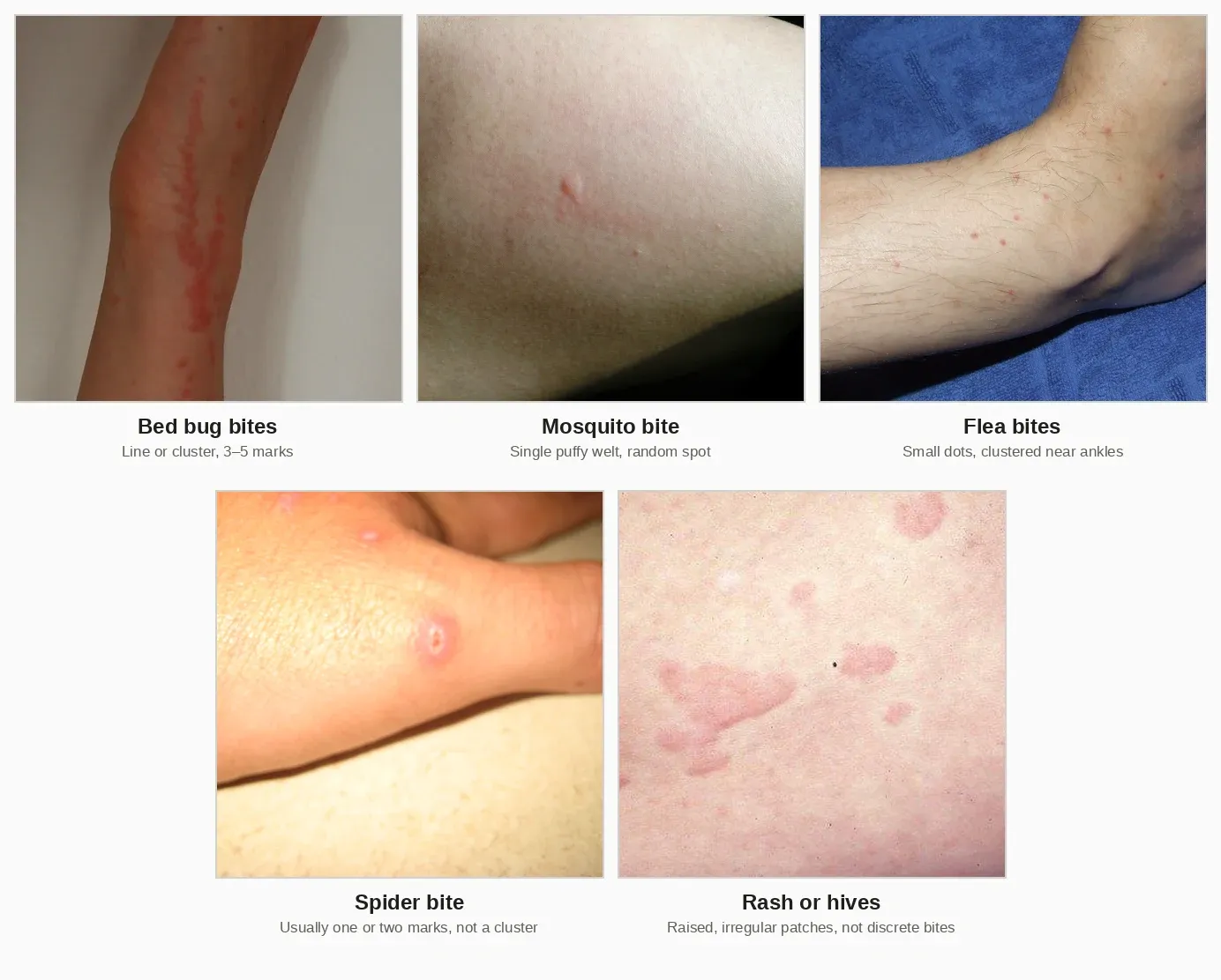 Five-panel comparison of skin reactions: bed bug bites in a line and cluster along a forearm, a single puffy mosquito bite, small flea bites clustered near an ankle, a mild spider bite on a hand, and raised irregular hives on skin.